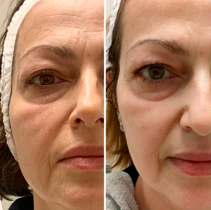 Eye & Cheek Area