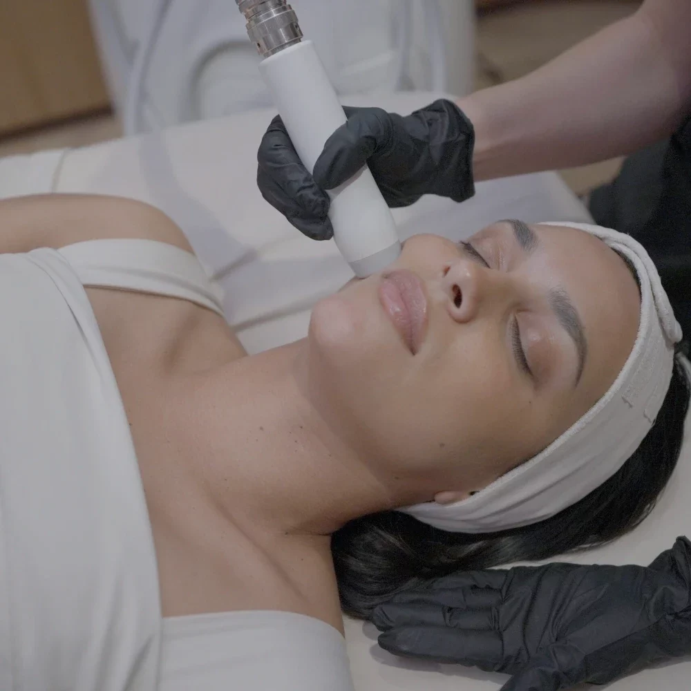 T-Shape facial treatment on the cheek at iCRYO Avon
